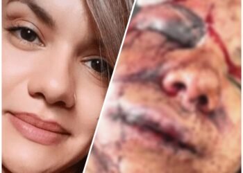 Juliana Garcia realiza cirurgia de reconstrução facial após sofrer mais de 60 socos dentro de elevador em Natal; procedimento levou cerca de 9h e foi bem sucedido 